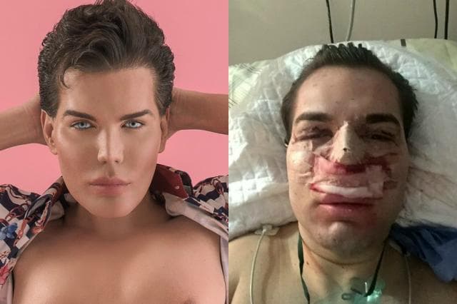 "Ken Humano" contrai bactéria e perde parte do nariz