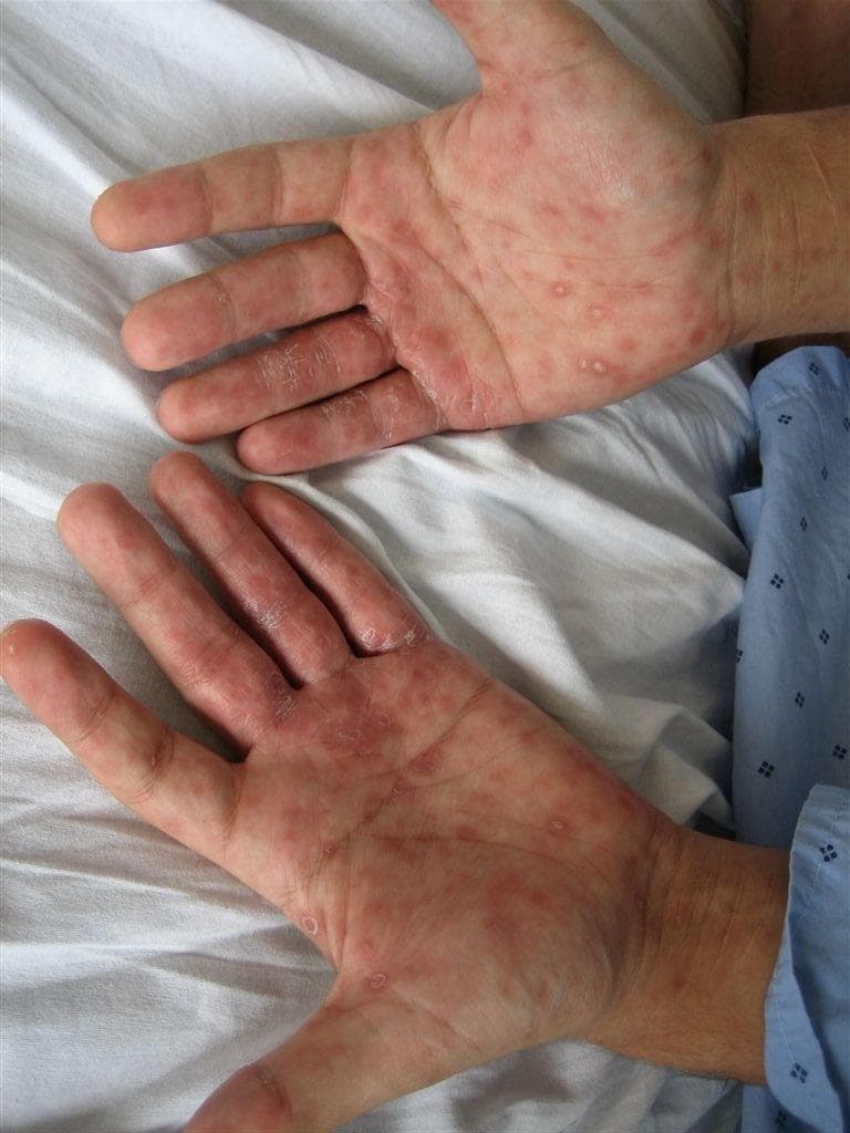 Aumenta a epidemia de sífilis no Brasil