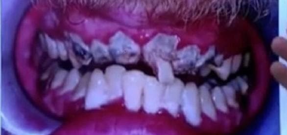 Jovem ficou 20 anos sem escovar os dentes. É mole?